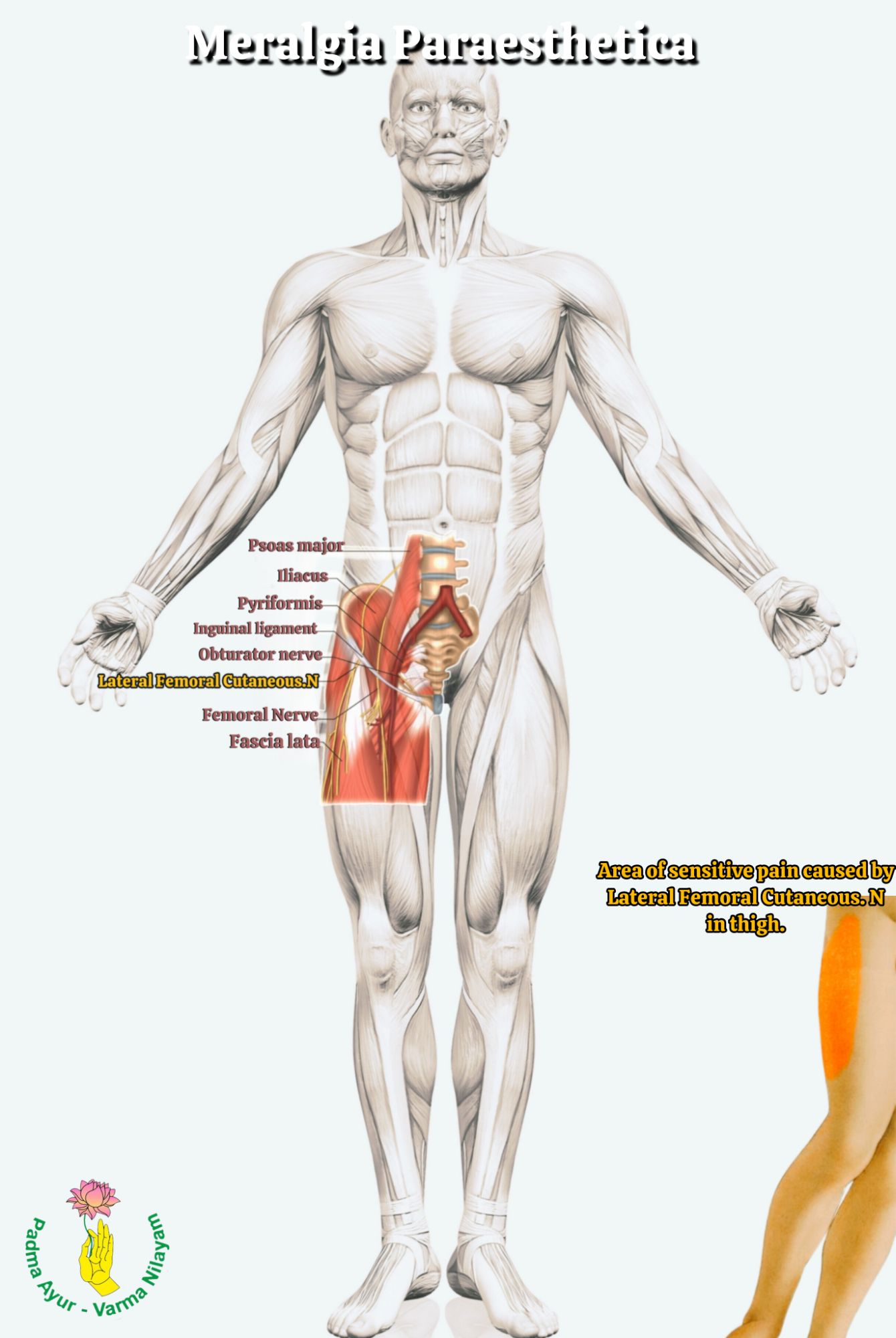 An super imposed image of thigh showing lateral cutaneous femoral nerve passing through the antero lateral section of thigh. Another image showing the areas of distribution of hypersensitive pain in thigh.